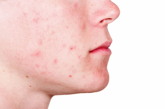 Acne Scarring