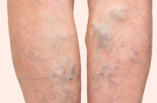 Veins Treatment
