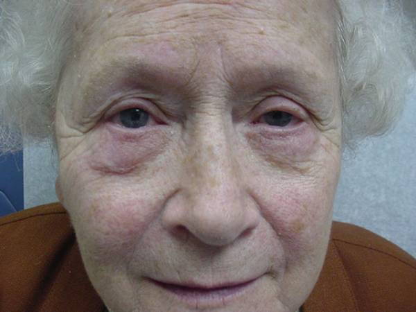 Close-up of an elderly person with drooping of the left upper eyelid (ptosis) and swelling under the left eye.