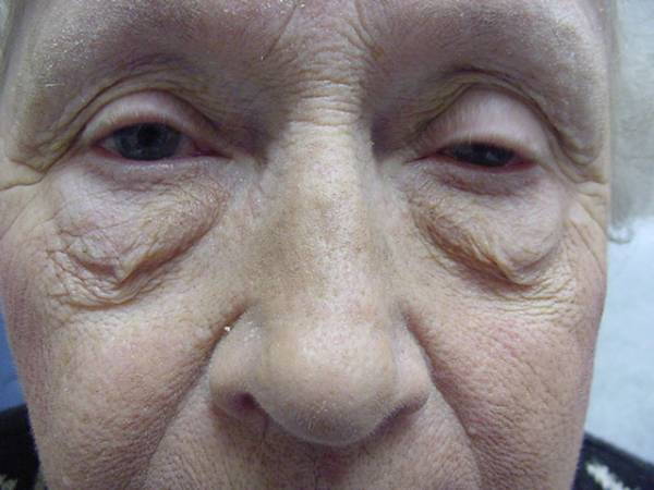 Close-up of an elderly person's face showing drooping of the right eyelid (ptosis) and differences in eye appearance.