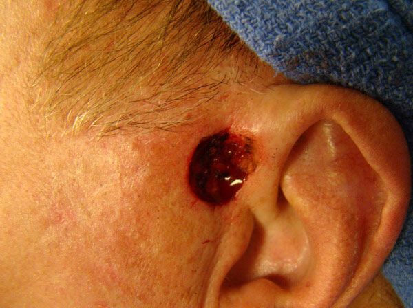 Close-up of a person's ear with a round, red, open wound on the skin just in front of the ear. The surrounding area appears irritated.