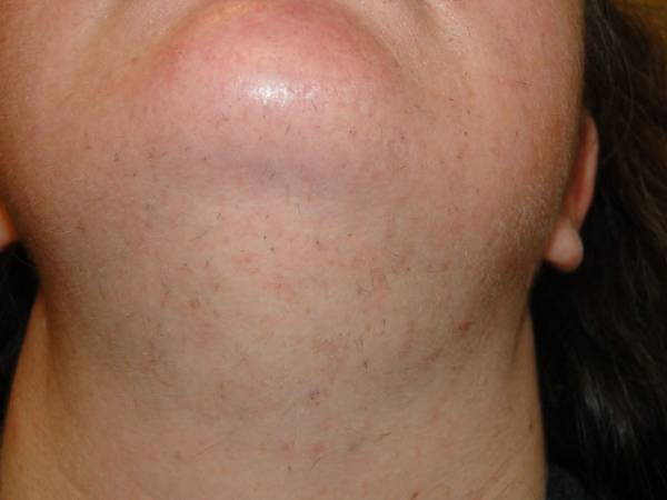 Close-up of a person's chin and neck showing sparse, short, dark facial hair and some skin texture differences.
