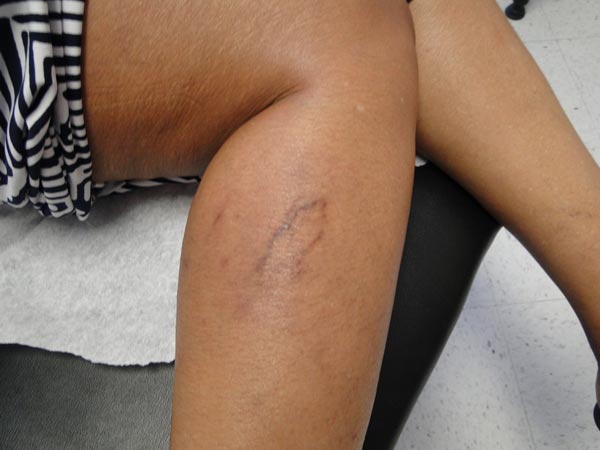 Vein Treatment Photo