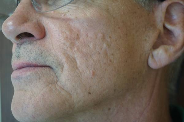 Close-up of an older man's cheek and jaw, showing textured skin with visible pores, wrinkles, and scars.
