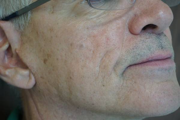 Close-up of an older man's face, showing wrinkles, age spots, light facial hair, and eyeglasses.