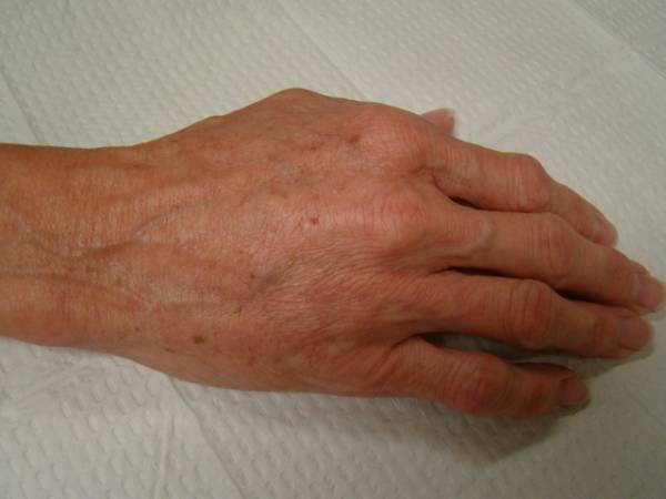 An adult hand with visible veins, wrinkles, and age spots resting on a white textured surface.