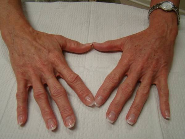 Two hands with visible veins and age spots are resting on a white textured surface; the person is wearing a wristwatch on the left wrist.