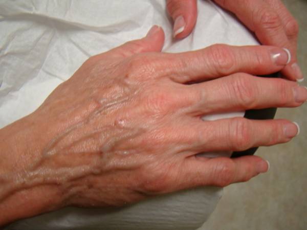 Close-up of an elderly person's hand resting on a white cloth, showing prominent veins, wrinkles, and natural signs of aging.