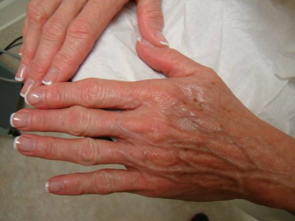 Two hands with visible veins and age spots rest on a white surface; both hands have neatly manicured nails with white tips.