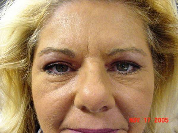 Close-up of a middle-aged woman with blonde hair, showing uneven swelling around her right eye. Date stamp on photo reads Nov 17, 2005.
