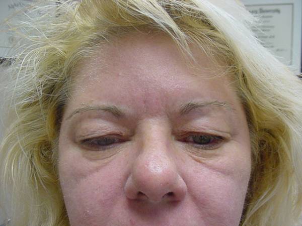 Close-up of a person's face showing swelling and puffiness around the eyes, and uneven skin texture, with light blond hair visible.