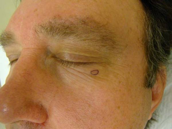 Close-up of a man's face with his eyes closed, showing a small circle marked on the skin near his right lower eyelid.