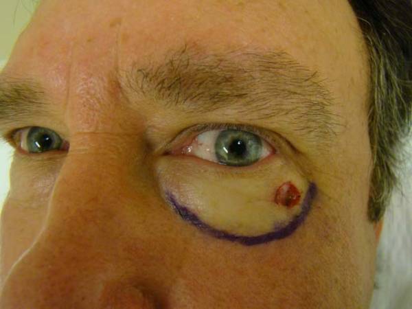 Close-up of a man's face showing a skin lesion below the left eye, with a purple marker line partially encircling the area.