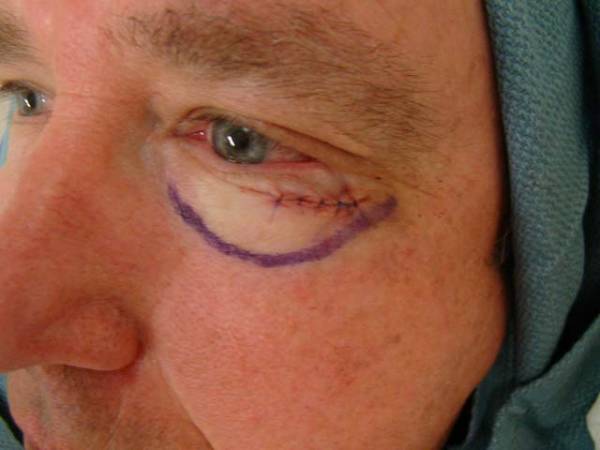 Close-up of a person's face showing stitches below the eye, with a purple surgical marking outlining the area, and part of a blue surgical cap visible.