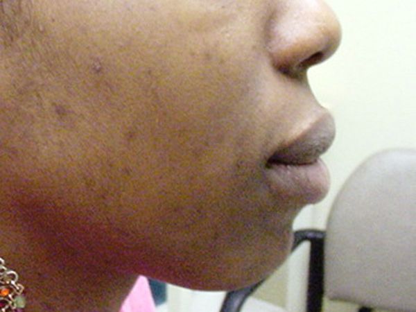 Close-up of the right side of a person's face and neck showing some mild acne scars and hyperpigmentation; an office chair is visible in the background.