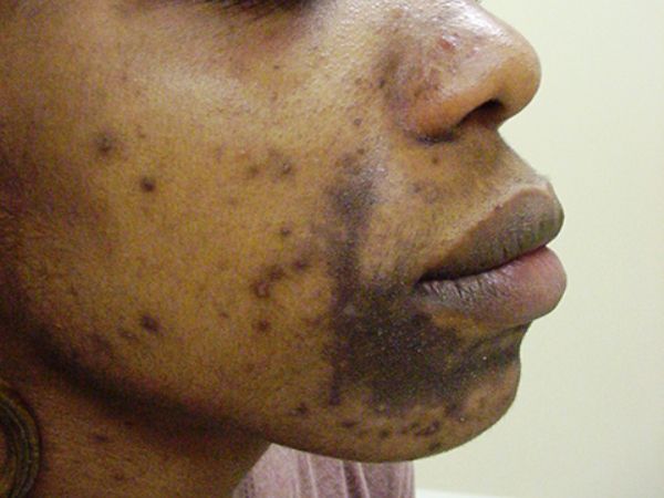 Close-up of a person's lower face and cheek showing hyperpigmentation, dark spots, and acne scars on brown skin.