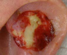 Close-up of a mouth ulcer with a red, inflamed border and a yellowish-white center on the tongue.