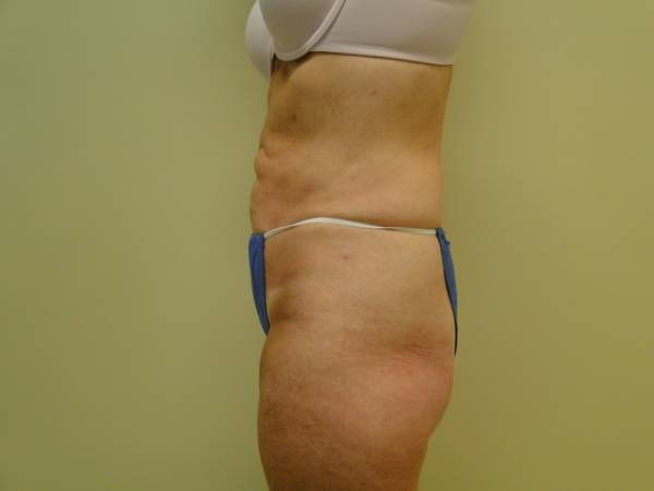 Side view of a person wearing a white bra and blue underwear, showing loose skin and some fat on the abdomen and hips against a plain background.