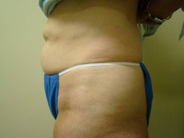 Person standing sideways, exposing their midsection with visible abdominal fat and skin folds, wearing blue bottoms and a white waistband.