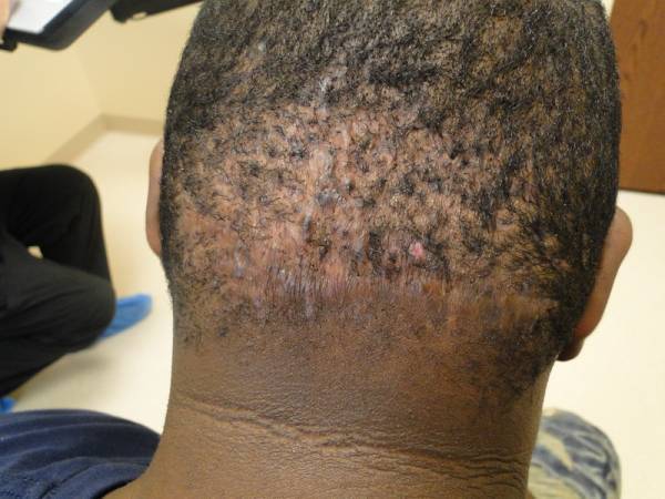The back of a person's head with visible patchy hair loss and inflamed bumps on the scalp and neck area.