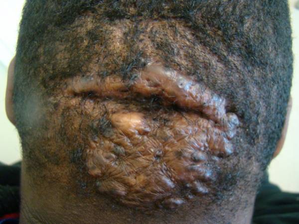 Close-up of the back of a person's scalp showing raised, thickened, and scarred skin with hair loss in the affected area.