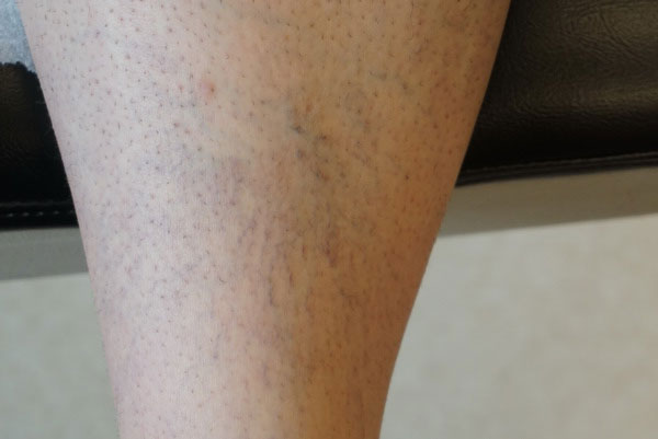 Vein Treatment Photo