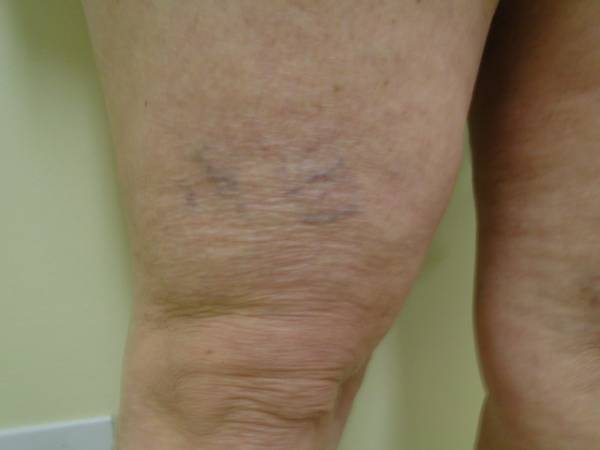Vein Treatment Photo