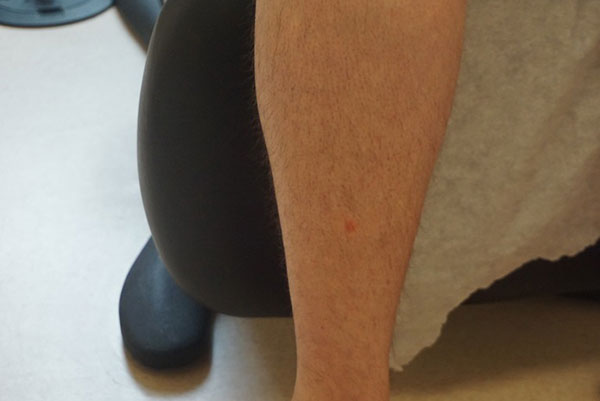 Vein Treatment Photo