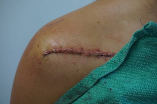 A close-up of a person's shoulder showing a long surgical incision closed with stitches and some redness around the wound.