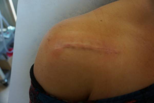 A close-up of a person's shoulder showing a healed surgical scar running horizontally across the skin.