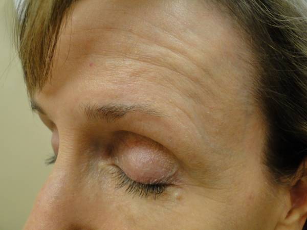 Close-up of a person's face with eyes closed, showing fine lines and wrinkles on the forehead and around the eyes.