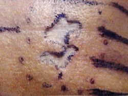 Close-up of skin showing clustered, irregularly shaped scars and dark ink markings, possibly pre-surgical or diagnostic reference points.