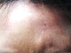 Close-up of a person's forehead showing hyperpigmentation and some scarring or discoloration on the skin.