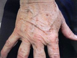 An elderly person's hand showing wrinkled skin and multiple brown age spots.