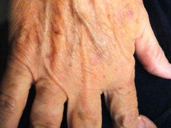 Close-up of the back of an older person's hand showing visible veins, wrinkles, and age spots against a dark background.