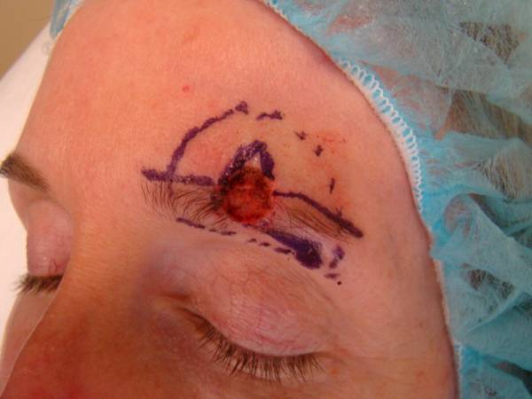 Close-up of a person's closed eye with a surgical cap on, showing a marked and open skin lesion or wound above the eyebrow.