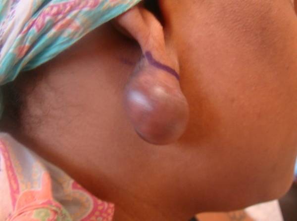 A close-up of a person's ear with a large, round keloid growth on the earlobe, marked by a purple line for possible medical intervention.