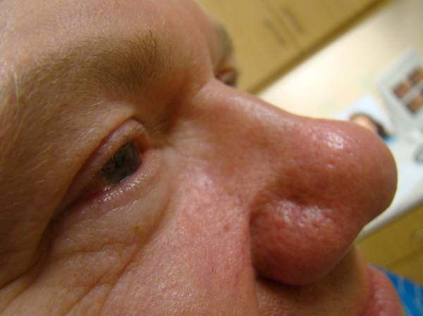 Close-up of a person's face showing a large, red, bumpy nose and part of one eye, indoors with cabinets visible in the background.
