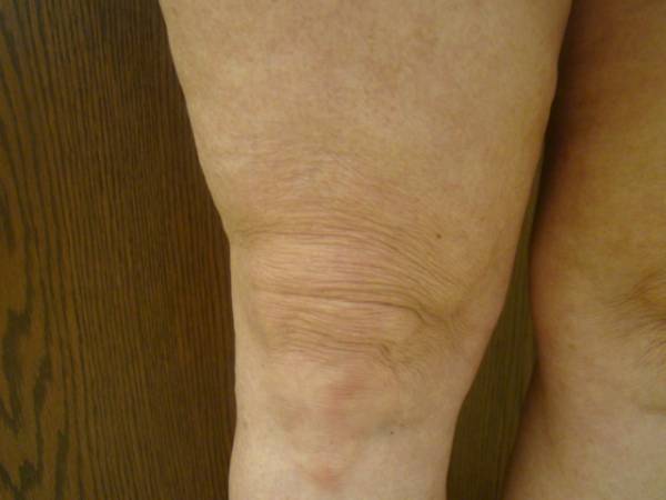 Vein Treatment Photo