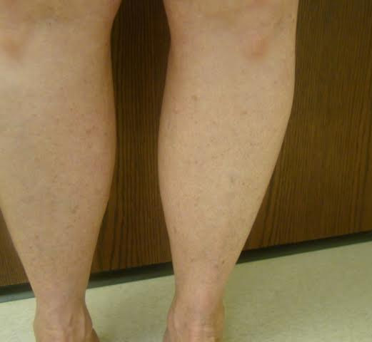 Vein Treatment Photo