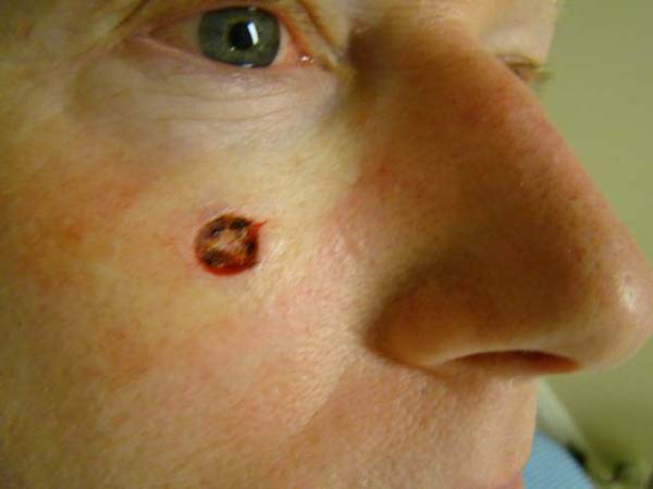 Close-up of a person's face showing a small, circular wound or lesion with a dark center on the left cheek, just below the eye.
