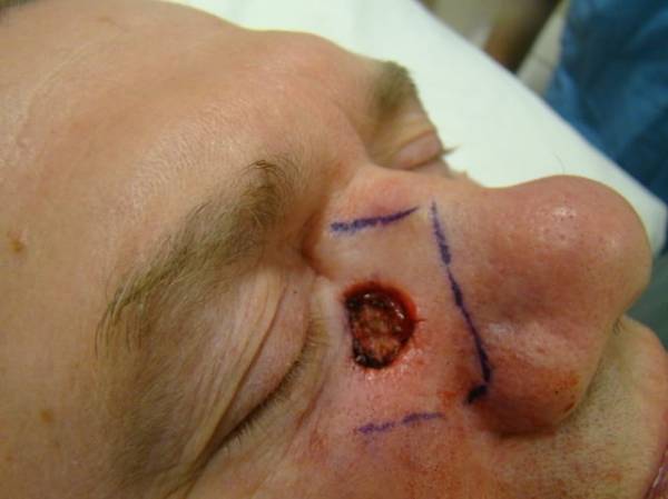 A person with a circular open wound on their cheek near the nose, surrounded by surgical markings drawn with a blue pen.