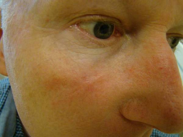 Close-up of a person's face showing mild redness and irritation on the cheek and around the nose.