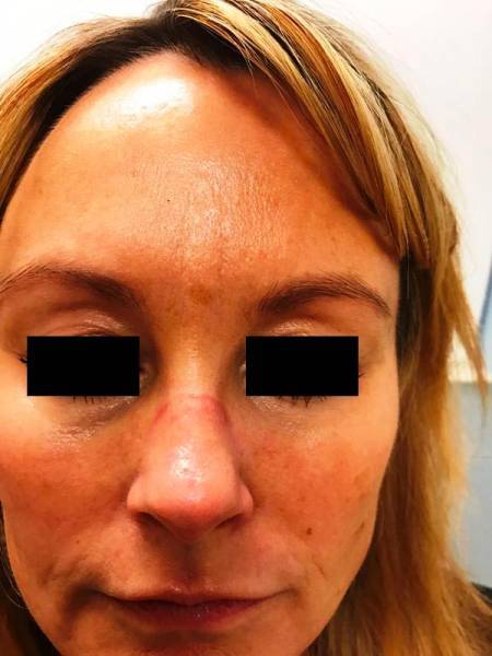 A person with light skin and blonde hair shows redness and irritation on the bridge of the nose.