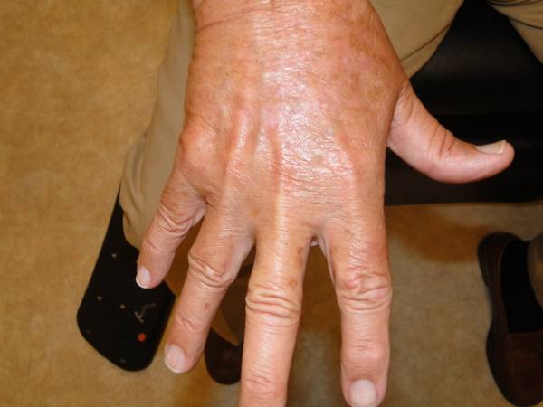 A close-up of a person's left hand and wrist showing prominent veins and slightly reddened, textured skin. The hand is resting palm down.