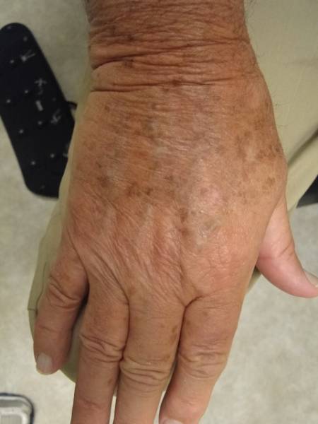 A close-up of an older person's hand showing age spots and visible veins against a neutral background.