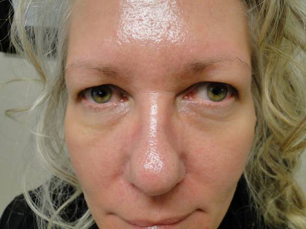 Close-up of a person’s face showing shiny, oily skin on the forehead, nose, and cheeks. The person has light skin, green eyes, and wavy, light-colored hair.