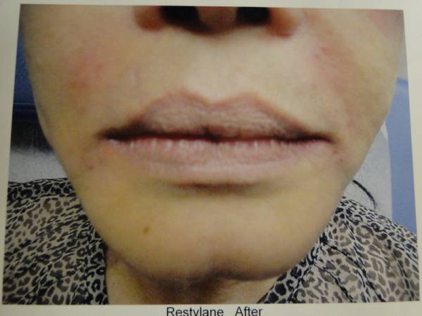 Close-up of a person's lower face showing lips and surrounding skin with subtle signs of swelling or cosmetic treatment; "Restylane After" partially visible at the bottom.