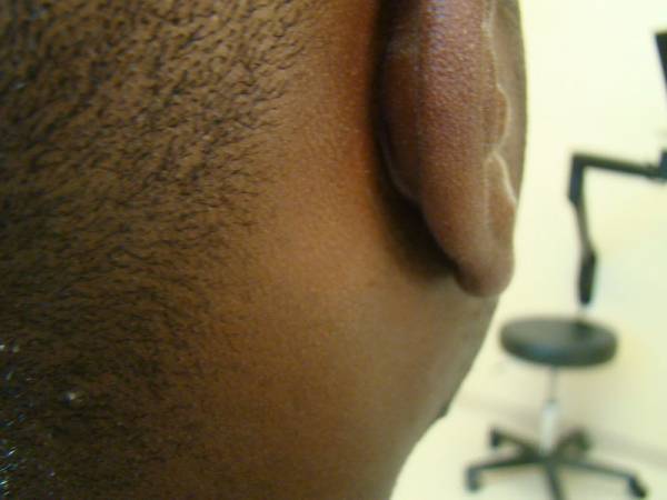 Close-up of the side of a person's head, focusing on the ear, with a blurred stool and ophthalmic equipment in the background.