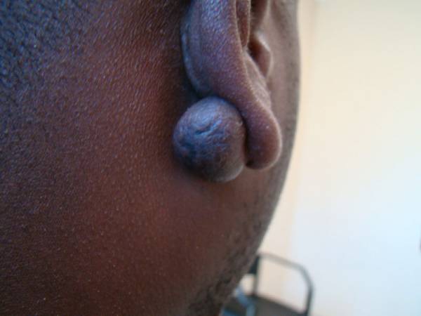 Close-up of a person's ear with a large, round keloid on the earlobe.